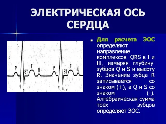 ЭЛЕКТРИЧЕСКАЯ ОСЬ СЕРДЦА Для расчета ЭОС определяют направление комплексов QRS