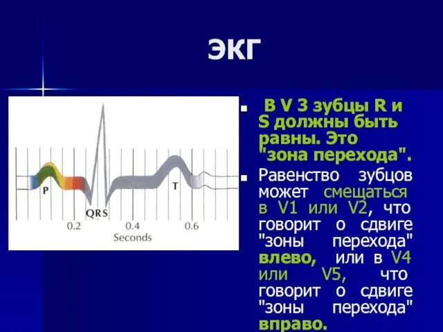 ЭКГ В V 3 зубцы R и S должны быть