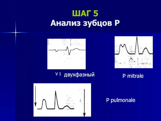 ШАГ 5 Анализ зубцов Р V 1 двухфазный P mitrale P pulmonale