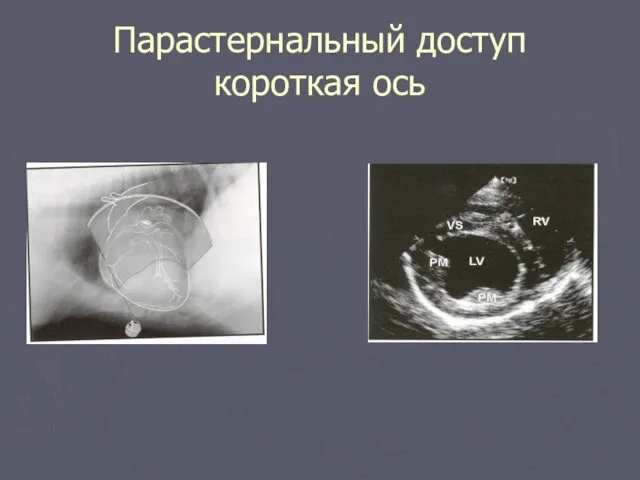 Парастернальный доступ короткая ось