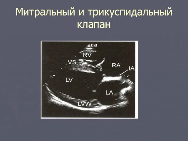 Митральный и трикуспидальный клапан