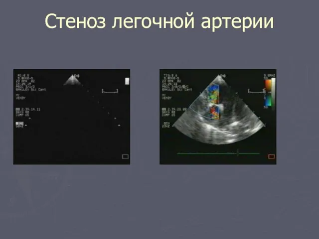 Стеноз легочной артерии