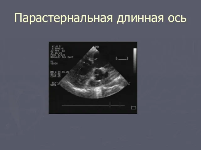 Парастернальная длинная ось