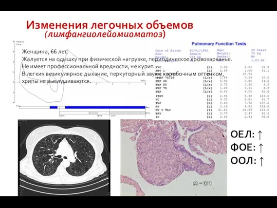 Изменения легочных объемов Женщина, 66 лет. Жалуется на одышку при