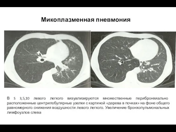 Микоплазменная пневмония В S 3,5,10 левого легкого визуализируются множественные перибронхиально
