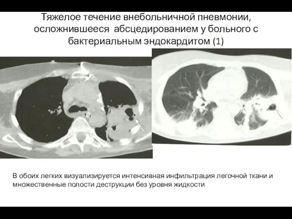 Тяжелое течение внебольничной пневмонии, осложнившееся абсцедированием у больного с бактериальным