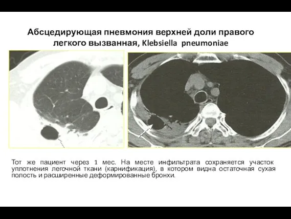 Абсцедирующая пневмония верхней доли правого легкого вызванная, Klebsiella pneumoniae Тот