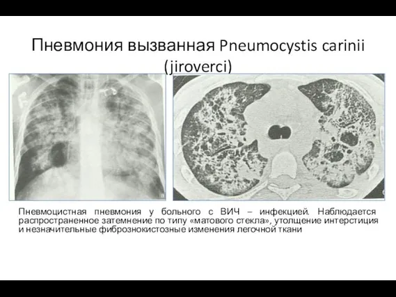 Пневмония вызванная Pneumocystis carinii (jiroverci) Пневмоцистная пневмония у больного с