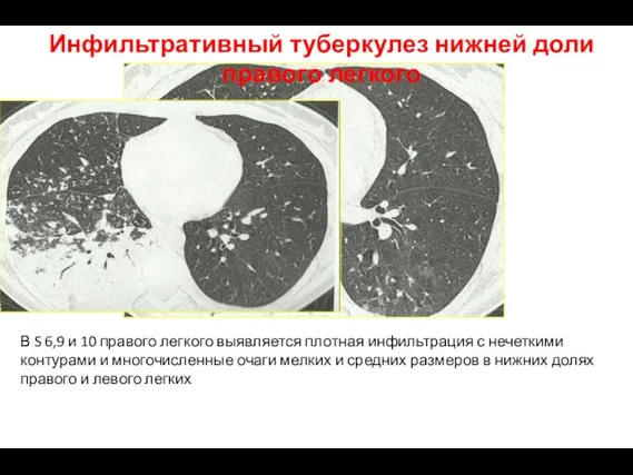 В S 6,9 и 10 правого легкого выявляется плотная инфильтрация