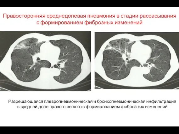 Правосторонняя среднедолевая пневмония в стадии рассасывания с формированием фиброзных изменений