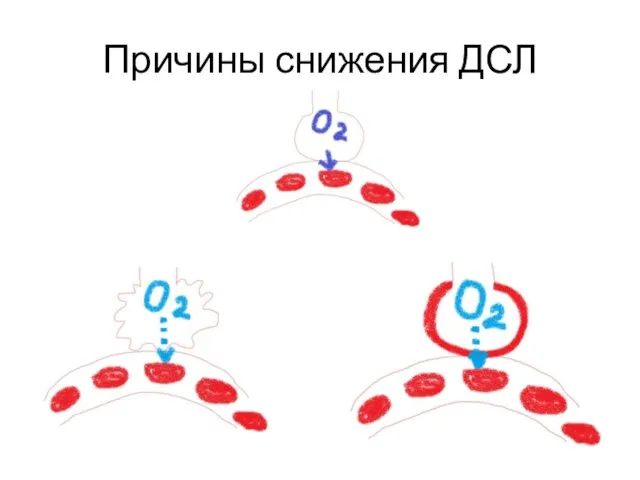 Причины снижения ДСЛ