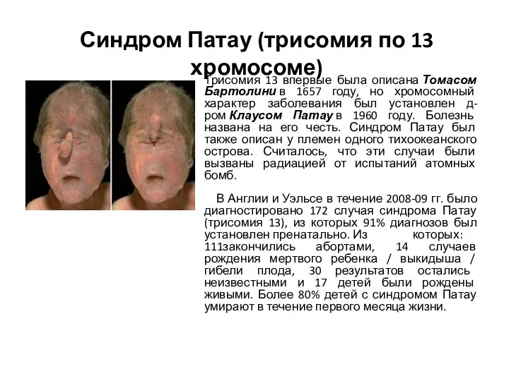 Синдром Патау (трисомия по 13 хромосоме) Трисомия 13 впервые была