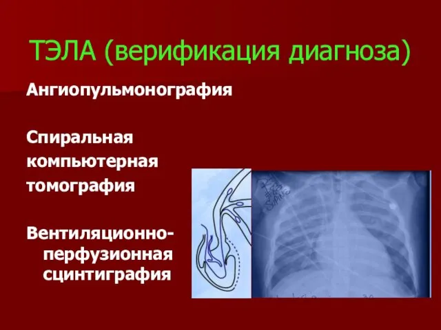 ТЭЛА (верификация диагноза) Ангиопульмонография Спиральная компьютерная томография Вентиляционно-перфузионная сцинтиграфия
