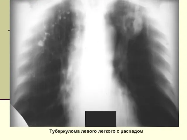 Туберкулома левого легкого с распадом