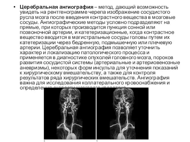 Церебральная ангиография – метод, дающий возможность увидеть на рентгенограмме черепа