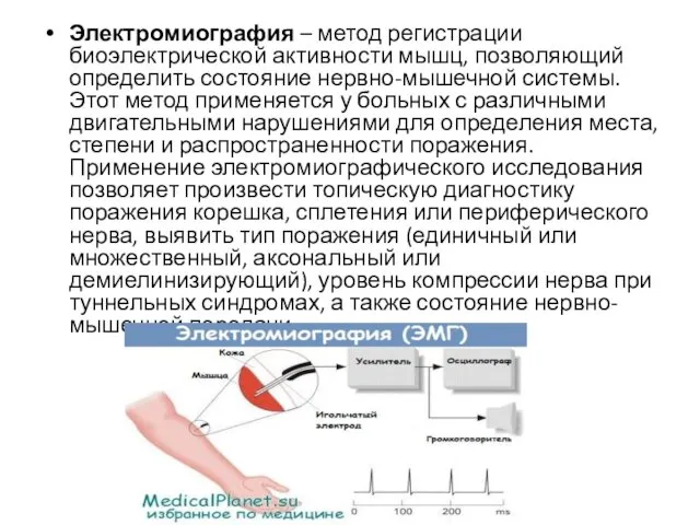 Электромиография – метод регистрации биоэлектрической активности мышц, позволяющий определить состояние