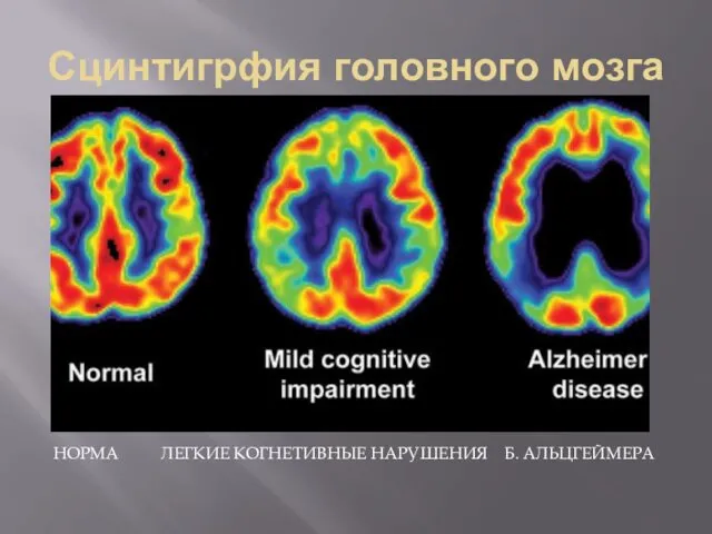 Сцинтигрфия головного мозга НОРМА ЛЕГКИЕ КОГНЕТИВНЫЕ НАРУШЕНИЯ Б. АЛЬЦГЕЙМЕРА