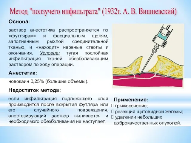 Метод "ползучего инфильтрата" (1932г. А. В. Вишневский) Основа: раствор анестетика
