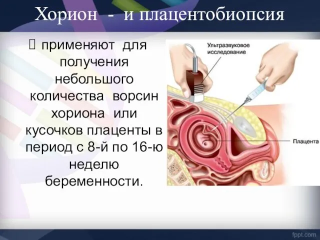 применяют для получения небольшого количества ворсин хориона или кусочков плаценты