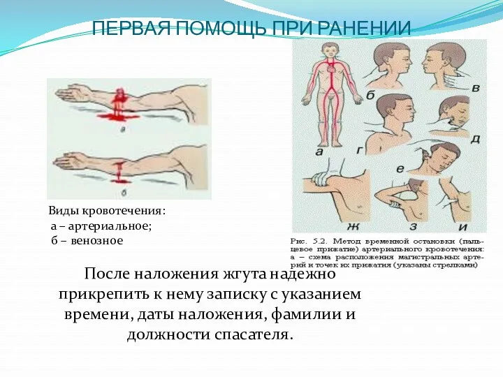 ПЕРВАЯ ПОМОЩЬ ПРИ РАНЕНИИ Виды кровотечения: а – артериальное; б