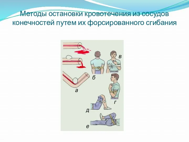 Методы остановки кровотечения из сосудов конечностей путем их форсированного сгибания