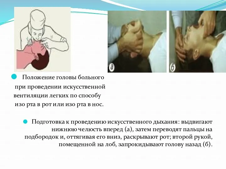 Положение головы больного при проведении искусственной вентиляции легких по способу изо рта в