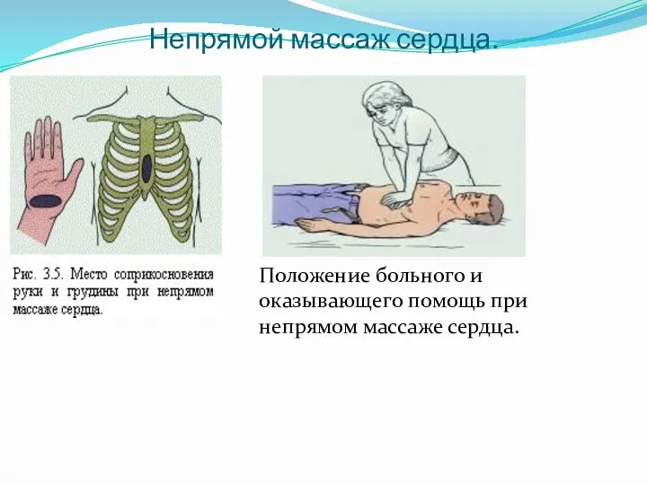 Непрямой массаж сердца. Положение больного и оказывающего помощь при непрямом массаже сердца.