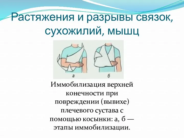 Растяжения и разрывы связок, сухожилий, мышц Иммобилизация верхней конечности при