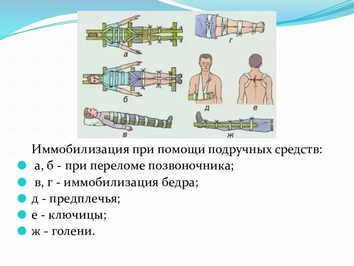 Иммобилизация при помощи подручных средств: а, б - при переломе