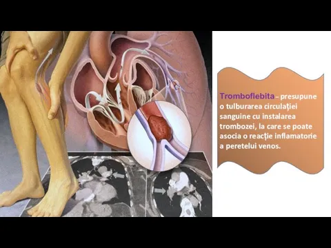 Tromboflebita – presupune o tulburarea circulației sanguine cu instalarea trombozei,