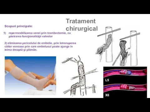 Scopuri principale: repermeabilizarea venei prin trombectomie, cu păstrarea funcţionalităţii valvelor