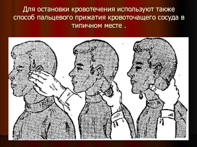 Для остановки кровотечения используют также способ пальцевого прижатия кровоточащего сосуда в типичном месте .