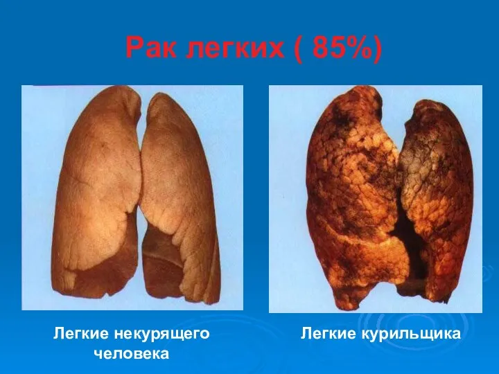 Рак легких ( 85%) Легкие некурящего человека Легкие курильщика