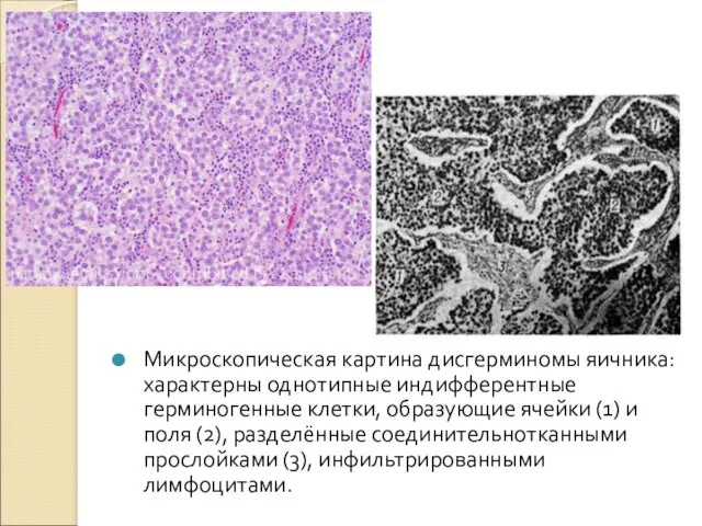 Микроскопическая картина дисгерминомы яичника: характерны однотипные индифферентные герминогенные клетки, образующие ячейки (1) и