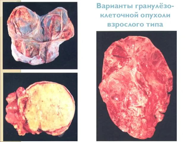 Варианты гранулёзо-клеточной опухоли взрослого типа