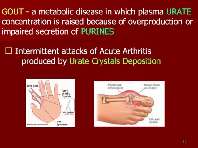 GOUT - a metabolic disease in which plasma URATE concentration is raised because