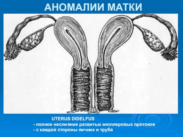 АНОМАЛИИ МАТКИ UTERUS DIDELFUS - полное неслияние развитых мюллеровых протоков