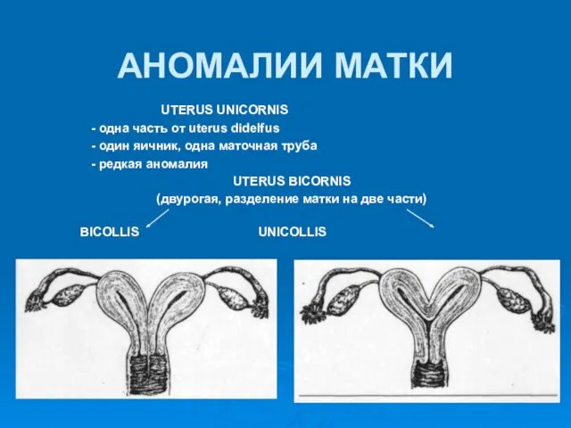 АНОМАЛИИ МАТКИ UTERUS UNICORNIS - одна часть от uterus didelfus