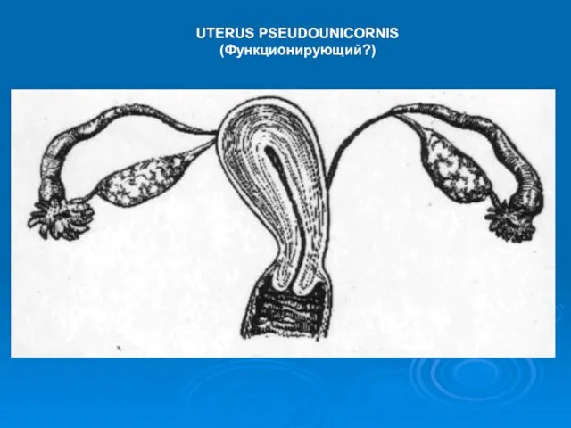 UTERUS PSEUDOUNICORNIS (Функционирующий?)