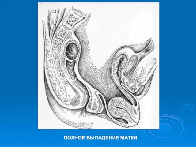 ПОЛНОЕ ВЫПАДЕНИЕ МАТКИ