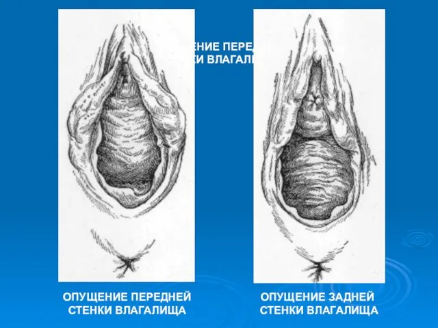 ОПУЩЕНИЕ ПЕРЕДНЕЙ СТЕНКИ ВЛАГАЛИЩА ОПУЩЕНИЕ ПЕРЕДНЕЙ СТЕНКИ ВЛАГАЛИЩА ОПУЩЕНИЕ ЗАДНЕЙ СТЕНКИ ВЛАГАЛИЩА