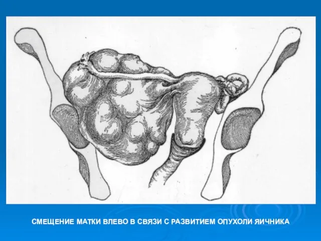 СМЕЩЕНИЕ МАТКИ ВЛЕВО В СВЯЗИ С РАЗВИТИЕМ ОПУХОЛИ ЯИЧНИКА