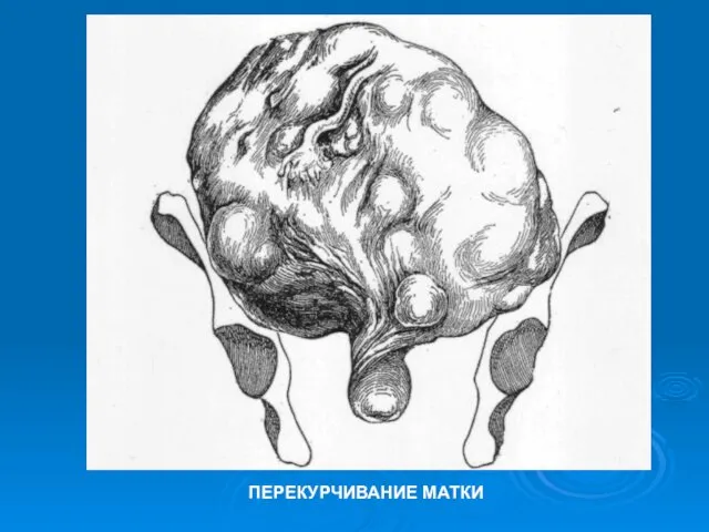 ПЕРЕКУРЧИВАНИЕ МАТКИ