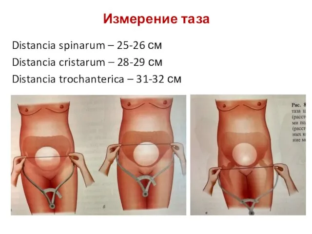 Измерение таза Distancia spinarum – 25-26 см Distancia cristarum –