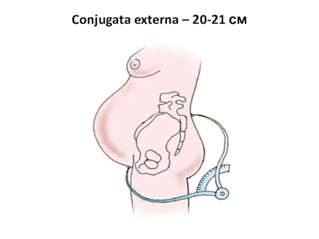 Conjugata externa – 20-21 см