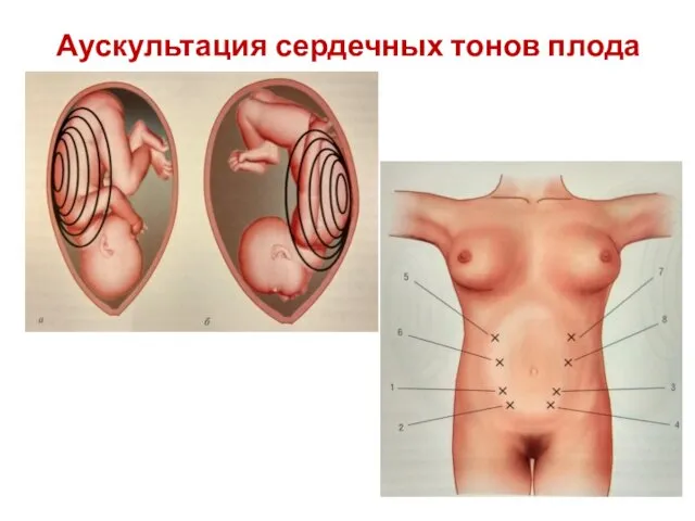 Аускультация сердечных тонов плода