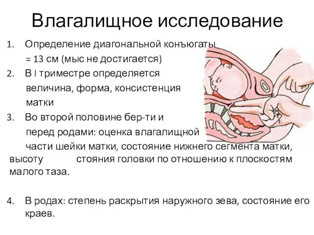 Влагалищное исследование Определение диагональной конъюгаты = 13 см (мыс не