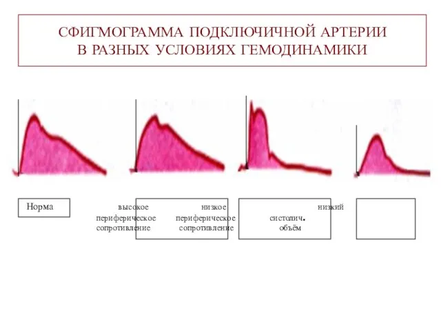 СФИГМОГРАММА ПОДКЛЮЧИЧНОЙ АРТЕРИИ В РАЗНЫХ УСЛОВИЯХ ГЕМОДИНАМИКИ Норма высокое низкое