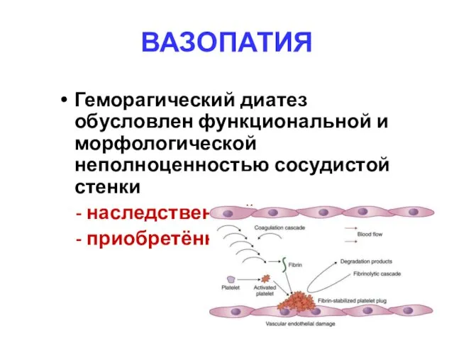 ВАЗОПАТИЯ Геморагический диатез обусловлен функциональной и морфологической неполноценностью сосудистой стенки - наследственный - приобретённый