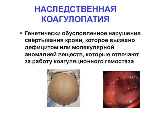 НАСЛЕДСТВЕННАЯ КОАГУЛОПАТИЯ Генетически обусловленное нарушение свёртывания крови, которое вызвано дефицитом